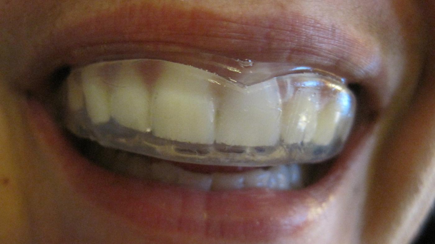 به‌طور کلی گارد دهان تنها دندانه‌ای بالایی را می‌پوشاند